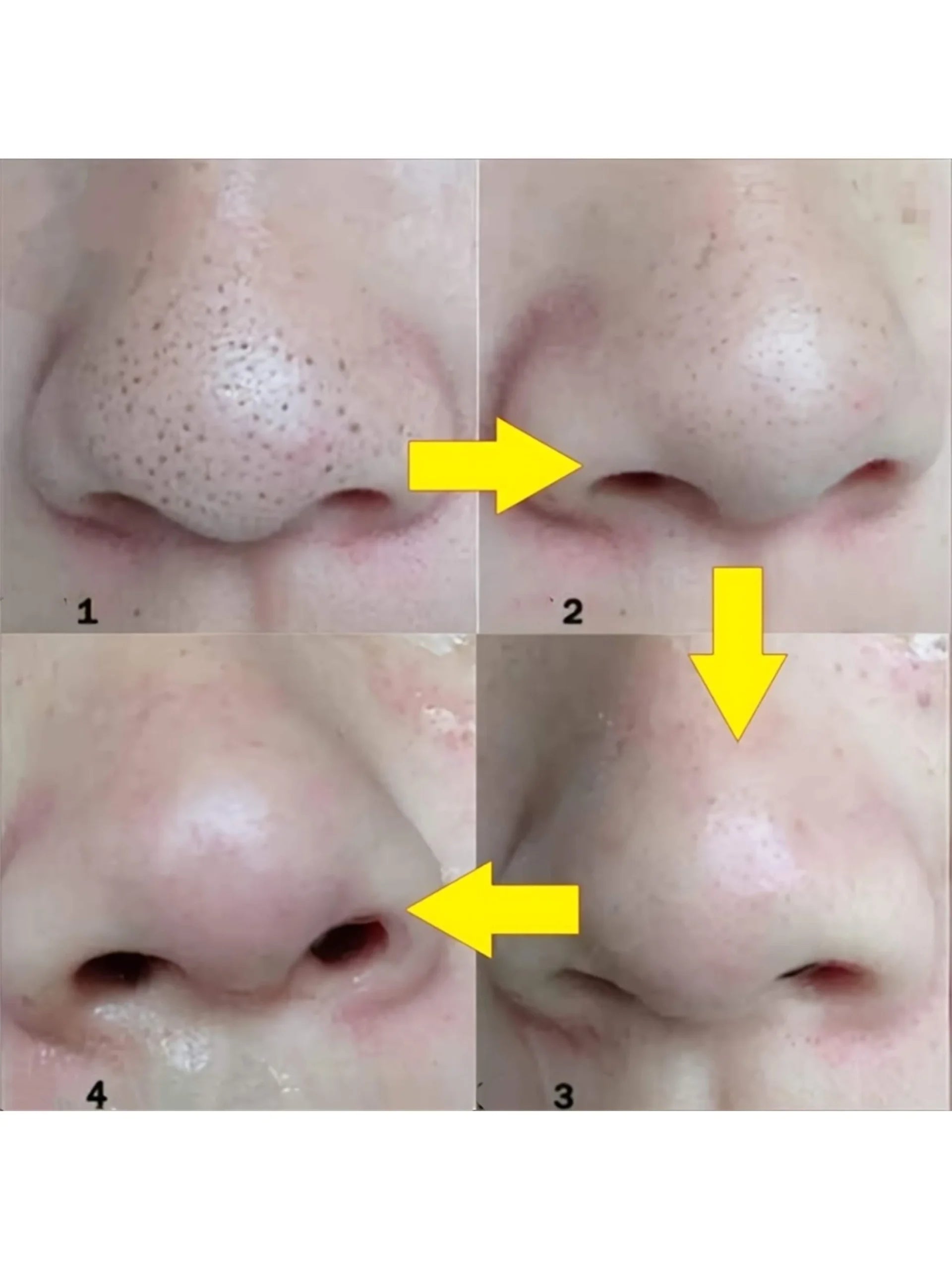 shein 15 Pcs Blackhead Nose Strips